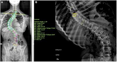 Vertebral body tethering: An alternative to posterior spinal fusion in idiopathic scoliosis?